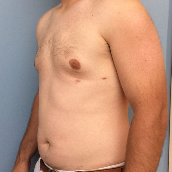 Gynecomastia Before and After Pictures Columbia, SC