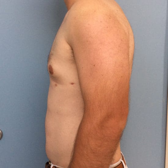 Gynecomastia Before and After Pictures Columbia, SC