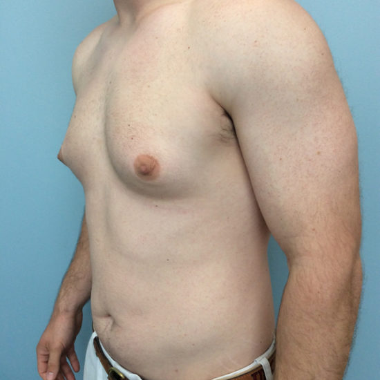 Gynecomastia Before and After Pictures Columbia, SC