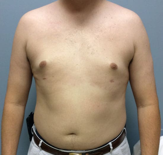 Gynecomastia Before and After Pictures Columbia, SC