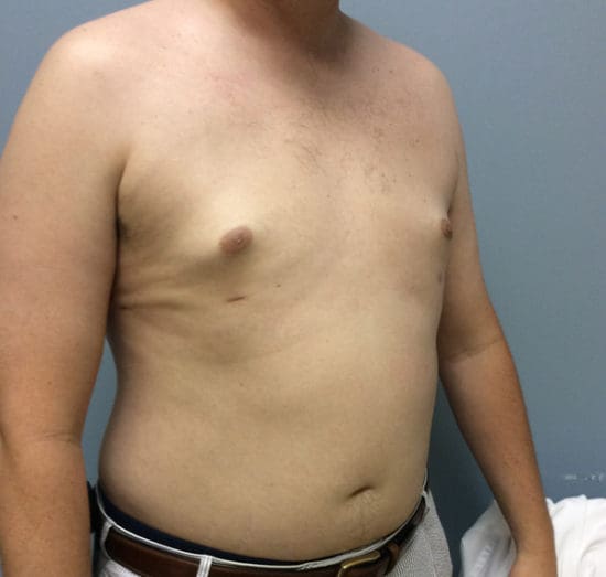 Gynecomastia Before and After Pictures Columbia, SC