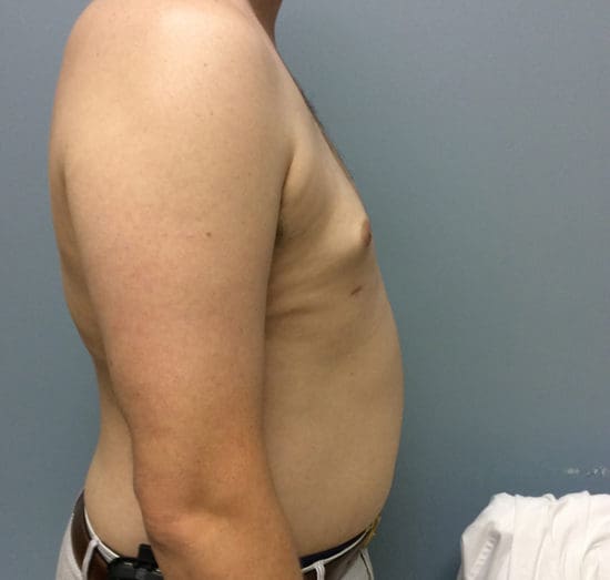 Gynecomastia Before and After Pictures Columbia, SC