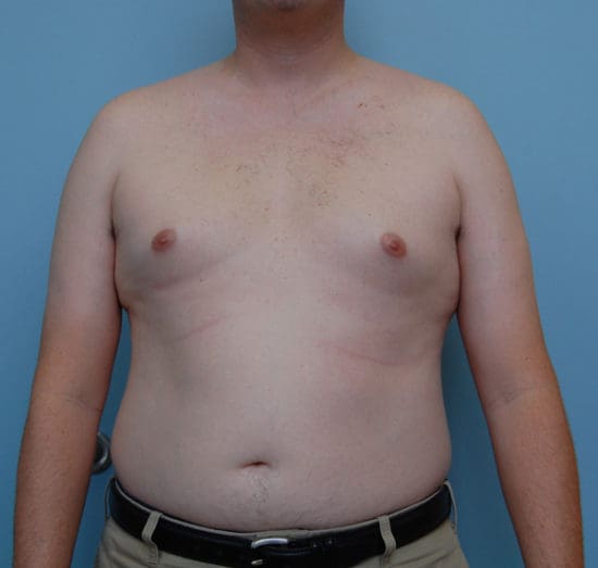 Gynecomastia Before and After Pictures Columbia, SC