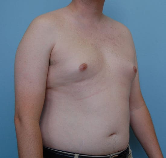 Gynecomastia Before and After Pictures Columbia, SC