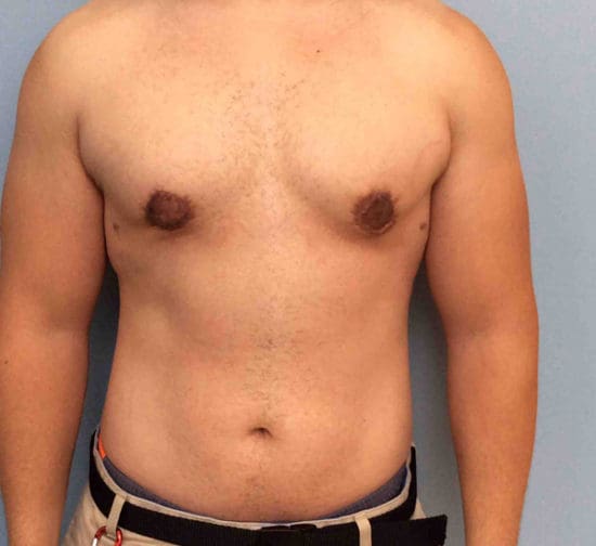 Gynecomastia Before and After Pictures Columbia, SC