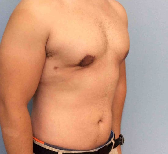 Gynecomastia Before and After Pictures Columbia, SC