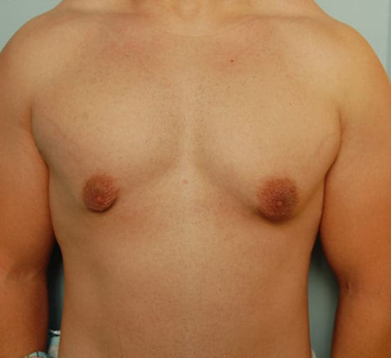 Gynecomastia Before and After Pictures Columbia, SC