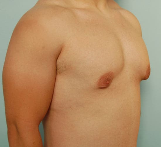 Gynecomastia Before and After Pictures Columbia, SC