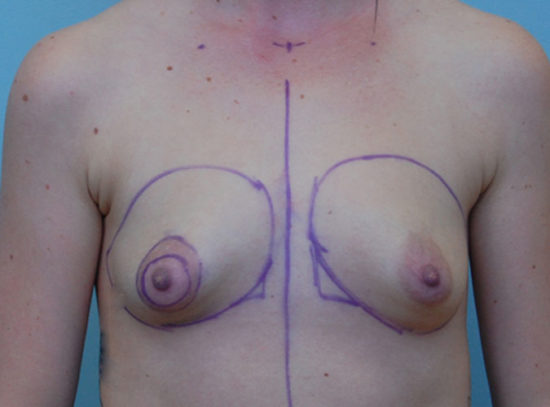 Breast Lift with Augmentation Before and After Pictures Columbia, SC