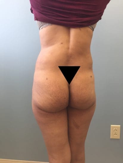 Liposuction Before and After Pictures Columbia, SC