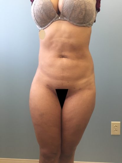 Liposuction Before and After Pictures Columbia, SC