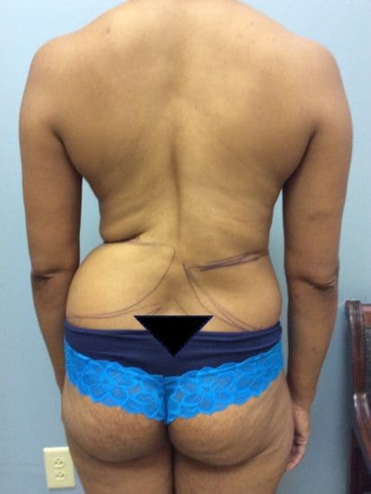 Liposuction Before and After Pictures Columbia, SC