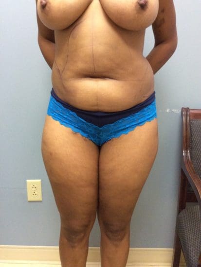 Liposuction Before and After Pictures Columbia, SC