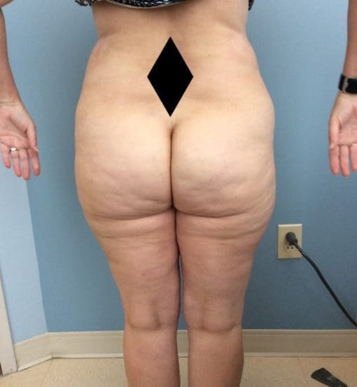 Liposuction Before and After Pictures Columbia, SC