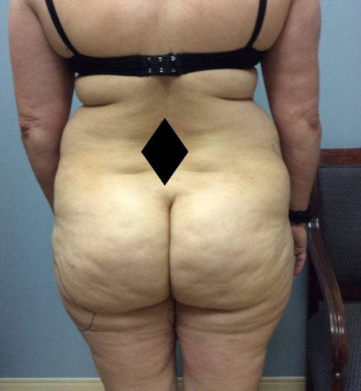 Liposuction Before and After Pictures Columbia, SC