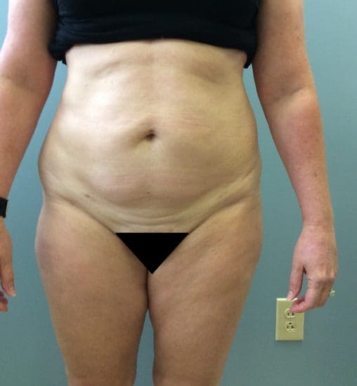 Liposuction Before and After Pictures Columbia, SC