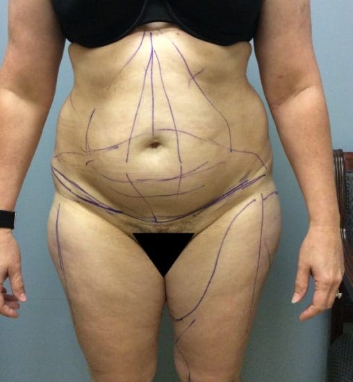 Liposuction Before and After Pictures Columbia, SC