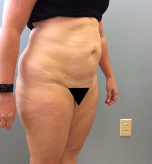 Liposuction Before and After Pictures Columbia, SC