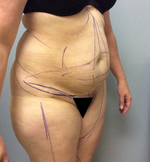 Liposuction Before and After Pictures Columbia, SC