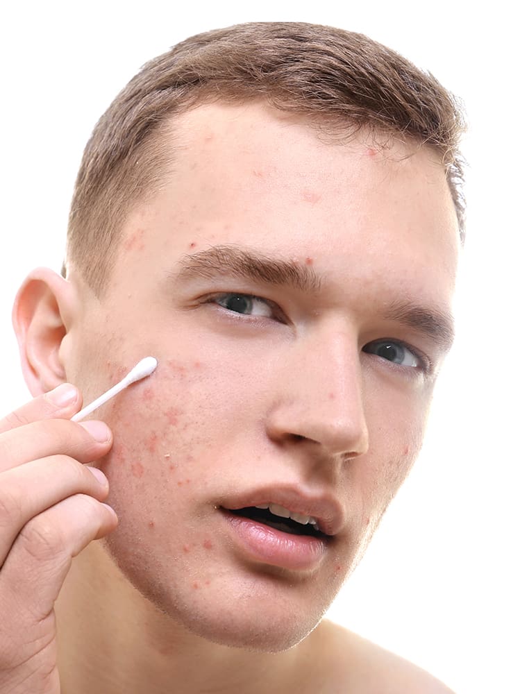 Acne Treatments in Columbia, SC