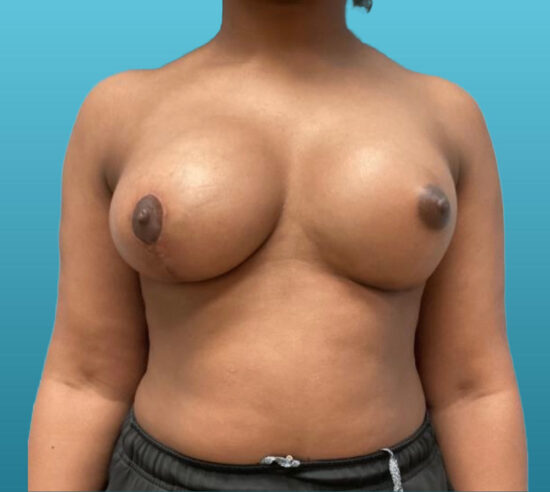 Complex Vertical Mastopexy Augmentation (right side) and Inframammary Augmentation (left side)