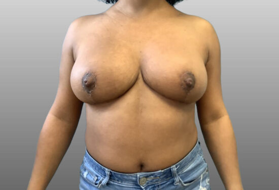 Breast Reduction Before and After Pictures in Columbia, SC