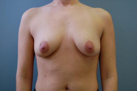 Complex Vertical Mastopexy Augmentation (right side) and Inframammary Augmentation (left side)