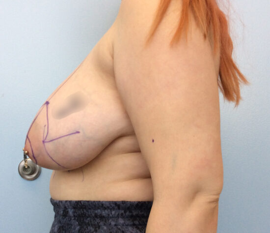 Breast Reduction Before and After Pictures in Columbia, SC