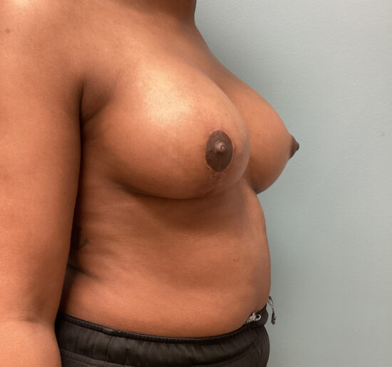 Complex Breast Surgery Before and After Pictures Columbia, SC