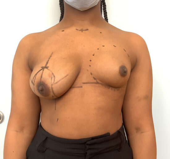 Complex Breast Surgery Before and After Pictures Columbia, SC