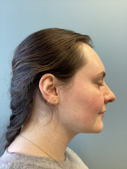 Neck Lift Before and After Pictures in Columbia, SC