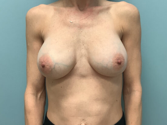 Breast Augmentation Before and After Pictures in Columbia, SC