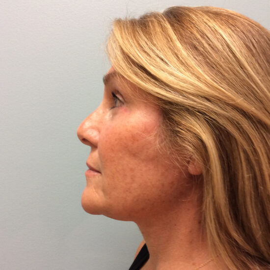 Facelift Before and After Pictures Columbia, SC