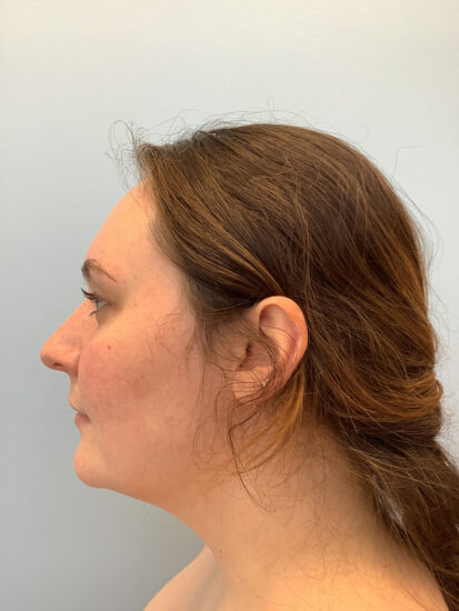 Neck Lift Before and After Pictures in Columbia, SC