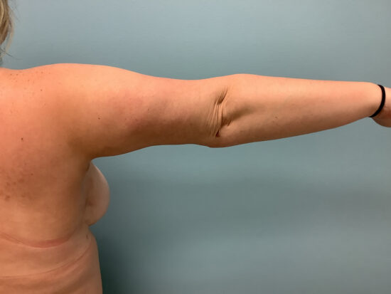 Brachioplasty Before and After Pictures in Columbia, SC